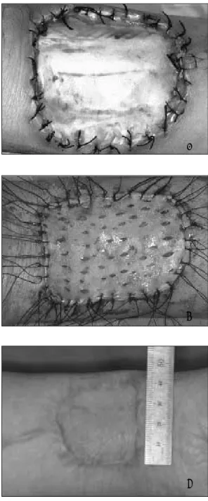 Fig. 5. Application of Terudermis � and split thickness skin graft.