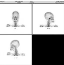 Fig. 7. Bone scan shows mildly increased uptake on right mandibular condyle.