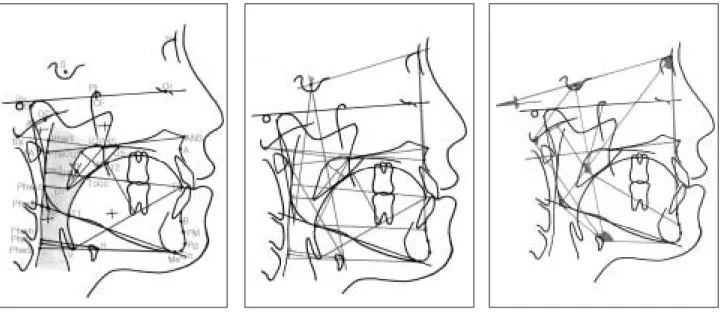 Fig. 1. Landmarks, Reference Lines. Fig. 2. Cephalometric Distances (mm). Fig. 3. Cephalometric Angles (� ).