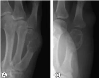 Fig. 1. Preoperative plain X-rays of right 5th metacarpal. 2.5