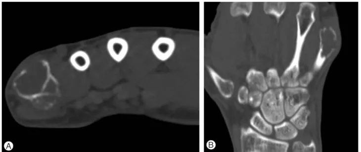 Fig. 2. Preoperative computed tomographic images of right hand. 2.5×1.7×1.6 cm sized expensile osteolytic mass lesion and septa-