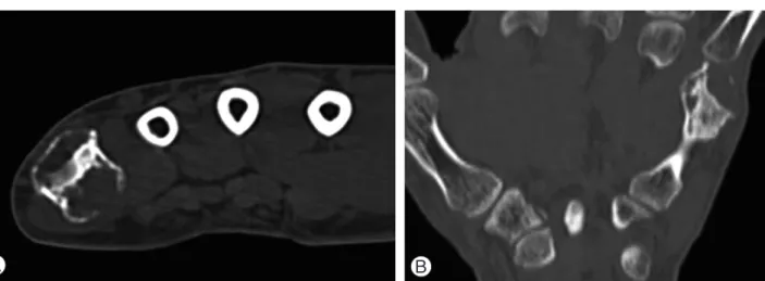 Fig. 6. 12 months follow up computed tomographic images of right hand. Compared with preoperative images, relatively small oste-