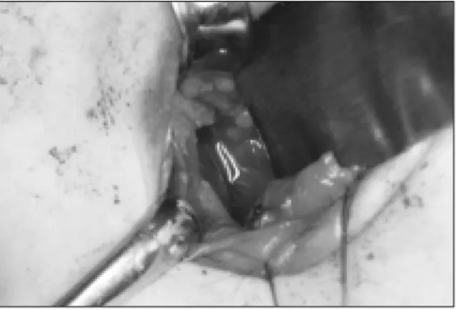 Fig. 5. Dissection. Fig. 6. Exposure of fracture site.