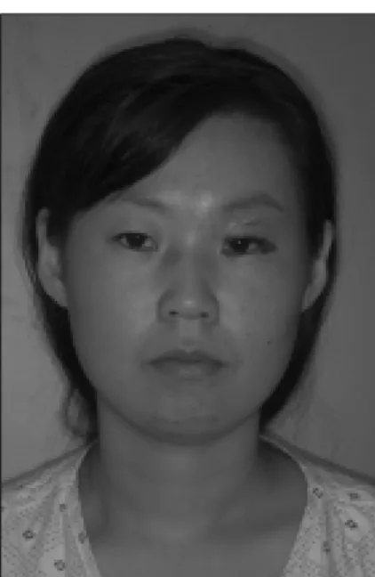 Fig. 11. Inferior view before surgery. Fig. 12. Inferior view after surgery.
