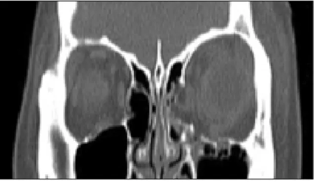 Fig. 15. Axial CT before surgery.  Fig. 16. Axial CT after surgery.