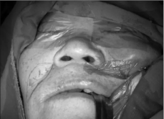 Fig. 5. Transposition of the nasolabial flap into the intra- intra-oral defect area through the tunnel.