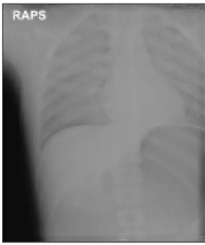 Fig. 1. Sequential radiographic(Chest AP or PA view) changes in this patient