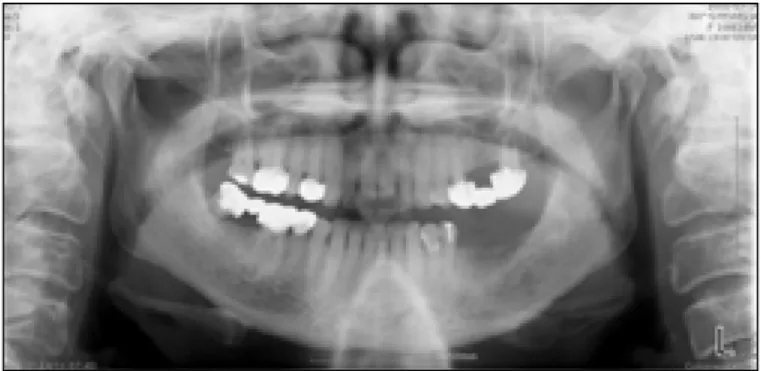 Fig. 2. Intraoperative view. The mass was well-demar- well-demar-cated from mandible.