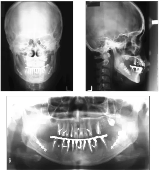 Fig. 4. Post-operative radiography.
