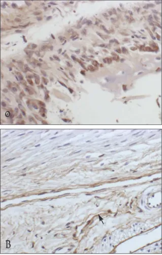 Table 1. Semi-Quantitative  Analysis  of  VEGF  and  VEGFRs  Staining  in  Cellualr  Components  of  the  Distracted Periosteum Following Mandibular Distraction Osteogenesis 