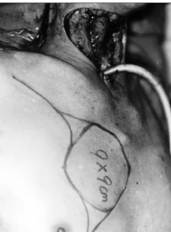 Fig. 2. Bipolar scissor. With this scissor bloodless cutting of