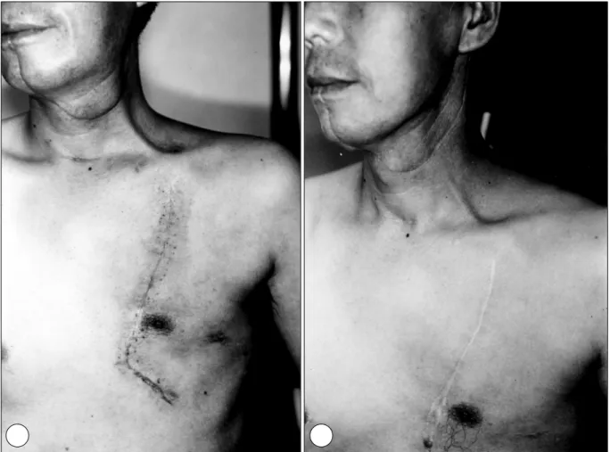 Fig. 4. A, B：Figures of patients neck, immediate postoperatively (4A)  and one years after true island type pectoralis