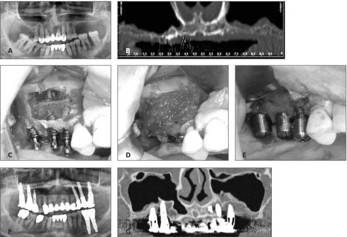 Fig. 2. (A &amp; B) Preoperative radiographs. The 1 mm or 2 mm remaining alveolar bones were observed in the both posterior areas of maxilla
