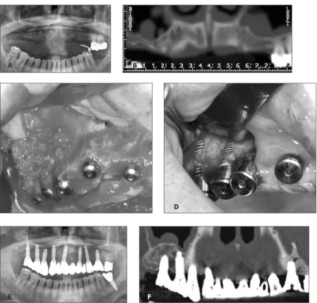 Fig. 3. (A &amp; B) Preoperative radiographs showing the poor quantity and quality of maxillary alveolar ridge