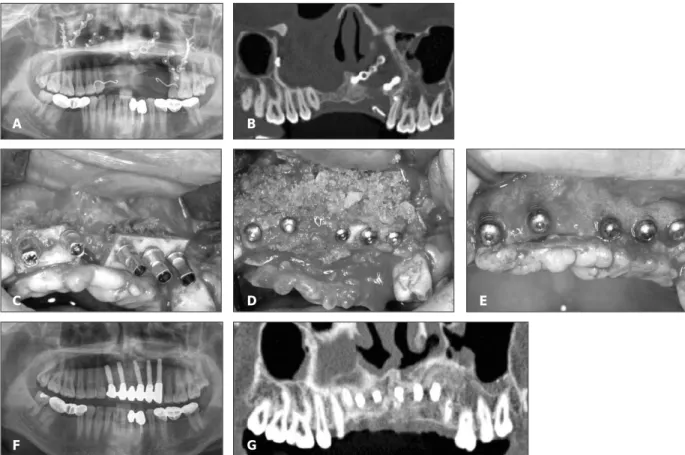 Table 2. ISQ Values at 6 Months Later of Simultaneous Implantation with Iliac Bone Graft  