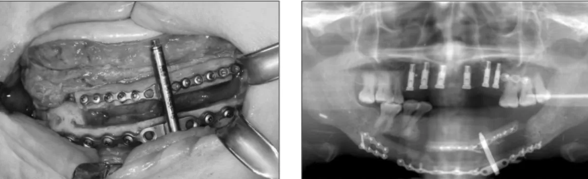 Fig. 2. The insertion of distraction device (right). Panoramic radiograph after finishing the distraction osteogenesis.
