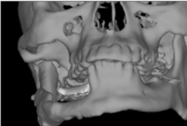 Fig. 9. Exposed  lower  plate  of  distractor  due  to  the severe postoperative infection.