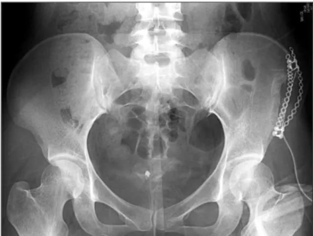 Fig. 1. The iliac crest contour was made with fixation of two smooth bended plates.