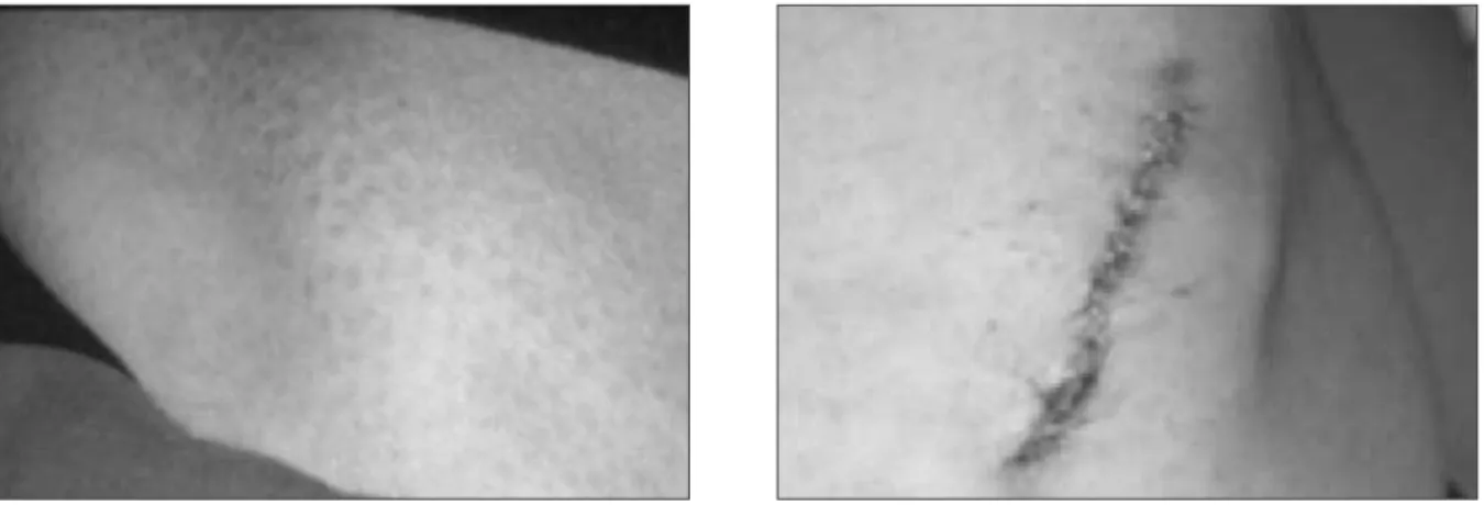 Fig. 4. Radiographic  view  2  year  after  iliac  contour reconstruction.
