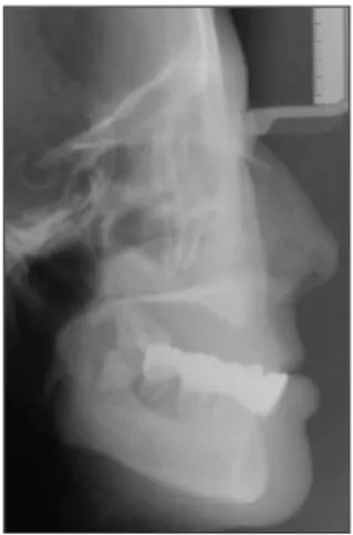 Fig. 1. Panoramic  view  shows  severe periodontitis  and  multiple  missing teeth.