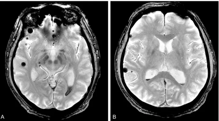 Figure 1. The findings of brain magnetic resonance (MR) image in case3. Gradient recalled echo (GRE) image shows bilateral  intraventricle hemorrhage in the posterior fossa and both tentorium