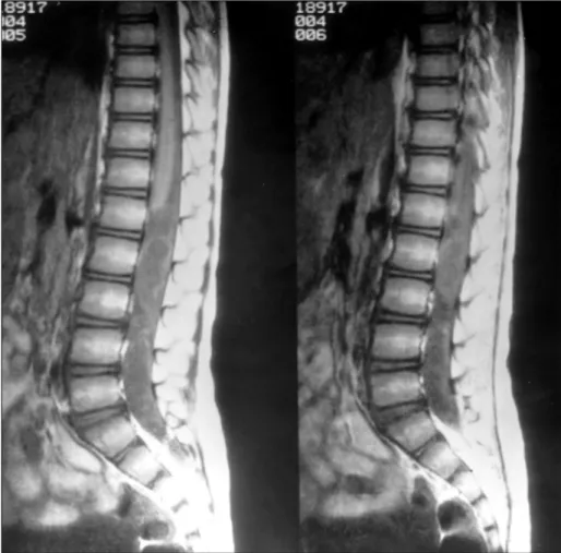 Fig. 1. Sagittal T1-weighted MR image shows intraspinal mass lesion extending from T12 to S1