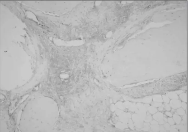 Fig. 16. Immunohistochemical  exam.  shows  PDGF expression  on  the  autogenous  bone  graft,  8  weeks (× 200).