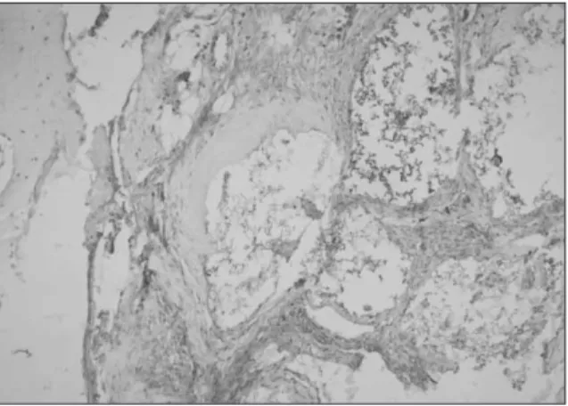 Fig. 24. Immunohistochemical  exam.  shows  PDGF expression  on  the  β-TCP  with  PRP  graft,  8  weeks (× 200).