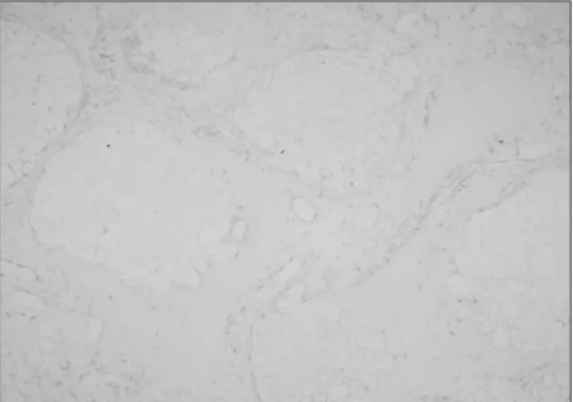 Fig. 28. Immunohistochemical  exam.  shows  BMP-4 expression  on  the  β-TCP  with  PRP  graft,  12  weeks (× 200).