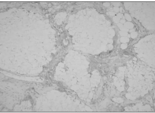 Fig. 32. Immunohistochemical  exam.  shows  PDGF expression on the β -TCP graft, 8 weeks (× 200).