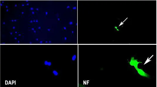 Fig. 2. Immunocytochemistry for neurofilament(NF). Cultured human mesenchymal stem cells stained for expression of NF that exhibits neuronal phenotype (green color, white arrow).