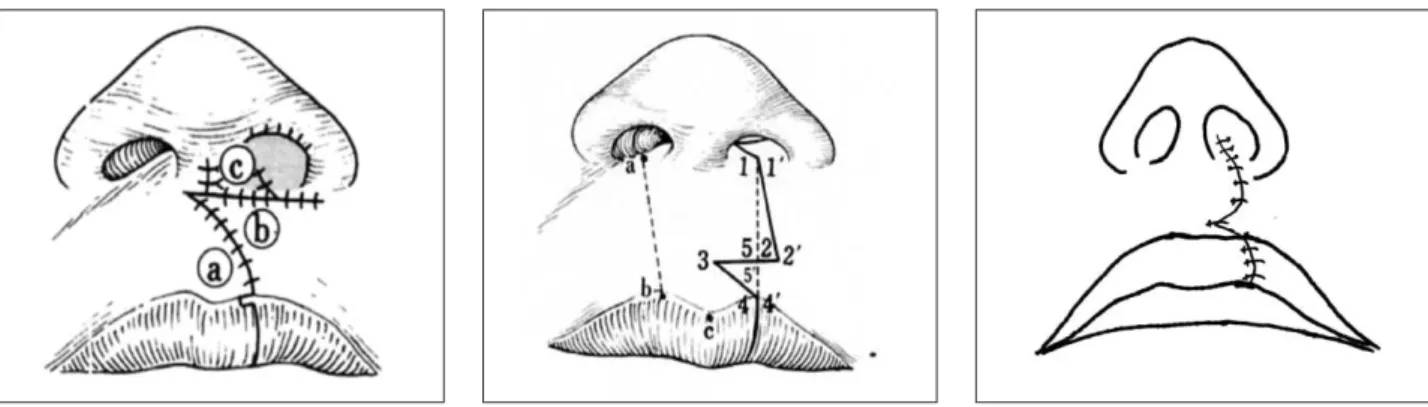 Fig. 7. The final result of cleft lip repair by using modified Millard’s method (left), Tennison-Randall method (center), and Bardach’s method (right).