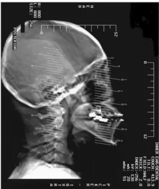 Fig. 1. Occlusal maxillary CT, all slices are parallel to the occlusal plan. 