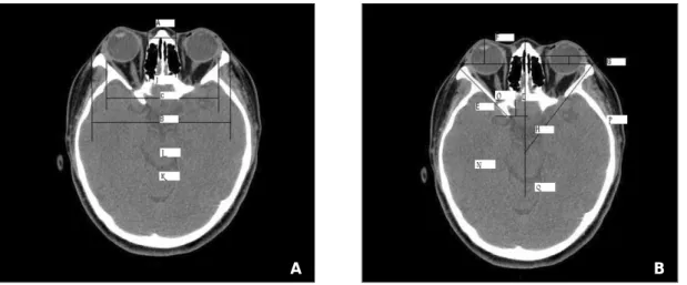 Fig. 2. The first slice for the evaluation of the orbit. (A) A: anterior interorbital distance, B: lateral orbital dis- dis-tance, C: intertemporal distance (B) D: medial orbital wall length, E: lateral orbital wall length, F: globe  pro-trusion G: medial 