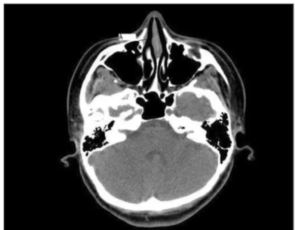Fig. 3. The second slice for the evaluation of the fron- fron-tonasal suture area. (A: thickness of the outer cortex of the frontonasal suture area) 