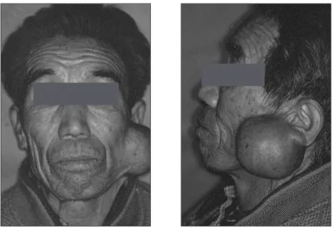 Fig. 1. Frontal and left lateral facial photographs at the initial examination showing a  large, hard and well circumscribed mass in the left preauricular area and the left mandibular ramus and angle region.