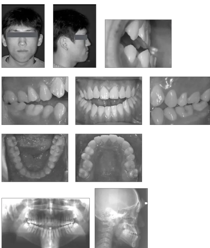 Fig. 6. A 17 years 2 months patient present with mandibular prognathism and vertical excess
