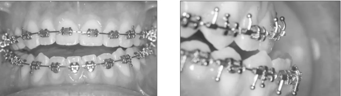 Fig. 9. Superimposition  of  pretreatment  and  posttreatment cephalometric radiographs.