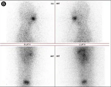 Figure 1. Pancreatic metastasis of papillary thyroid cancer. (A) 