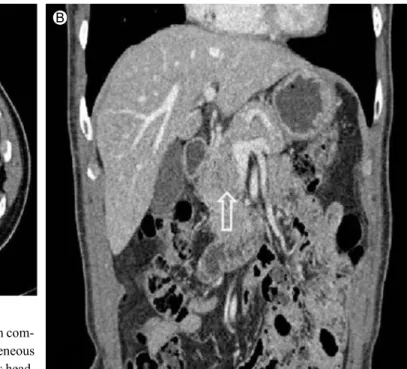Figure 3. EUS and contrast-enhanced EUS of the pancreatic mass. (A) EUS showed a well-defined, 29 × 25 mm sized round-shaped, 