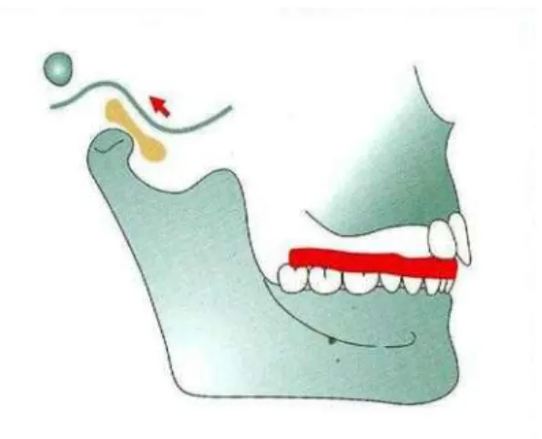 Fig. 2. Mimetic diagram that explains inducing stabilization of disc by wearing splint