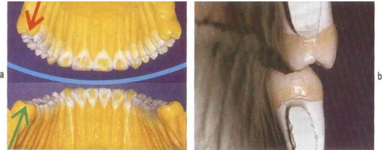 Fig. 3. The advantage of lower appliance(UCLA splint). It is easy to get retention and manufacture because of the lingualized lower tooth axis.