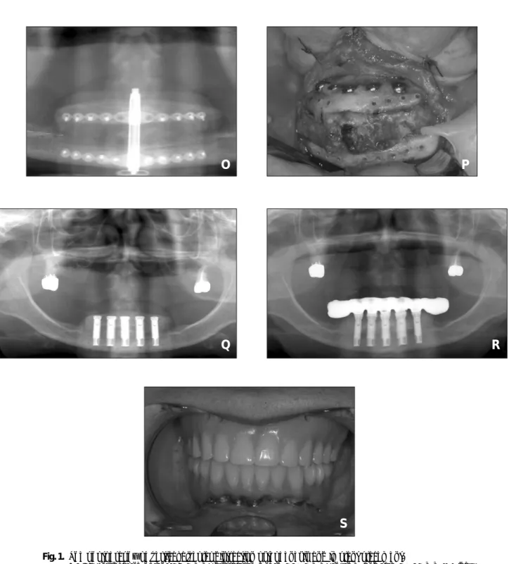 Fig. 1. The photography of vertical alveolar distraction osteogenesis and implant placement.