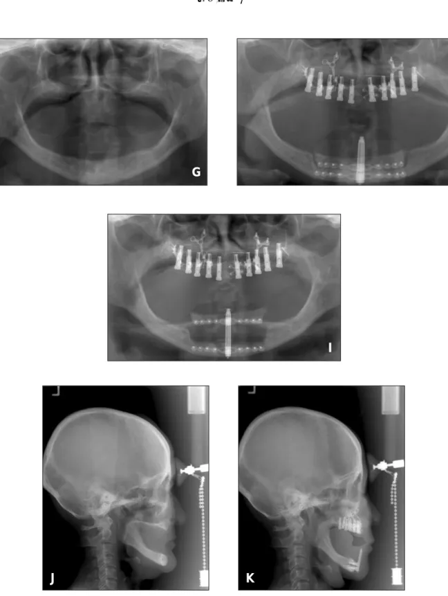 Fig. 2. The photography of LeFort I osteotomy maxillary advancement, both sinus lifting and sandwich bone graft  with  iliac  bone  graft  and  simultaneous  implant  installation(×10)  and  vertical  alveolar  DO  of mandible.