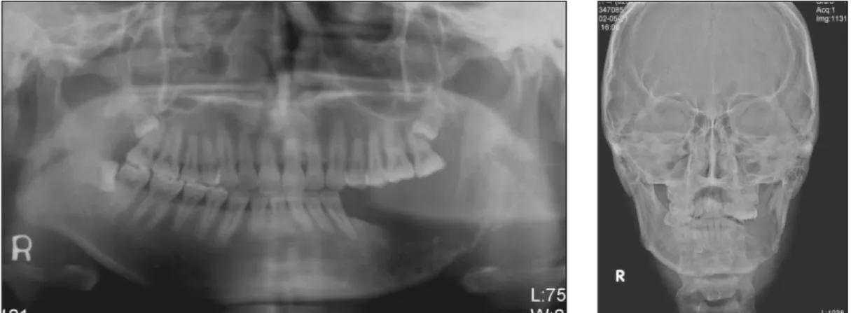 Fig. 2. Axial  CT  image  shows  bony  destruction  of  buccolingual  cortex  of  left mandible and coronal CT image shows destruction of lingual cortex