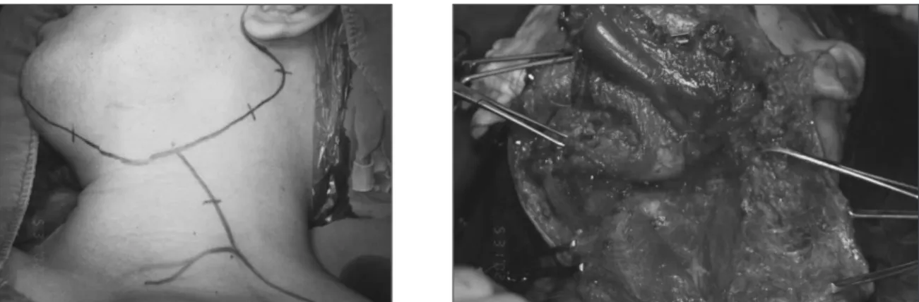 Fig. 3. Clinical photo shows incision line for radicular neck dissection and elevation of lymph nodes of level II, III, IV, V.