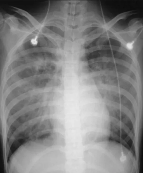 Fig. 2. Postoperative Chest P-A view