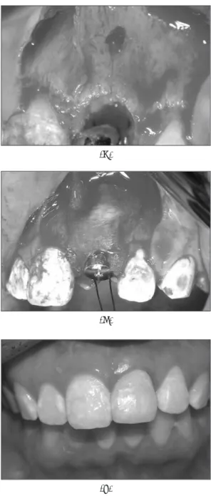 Fig. 1. Case of immediate implantation of upper left central incisor(#21).