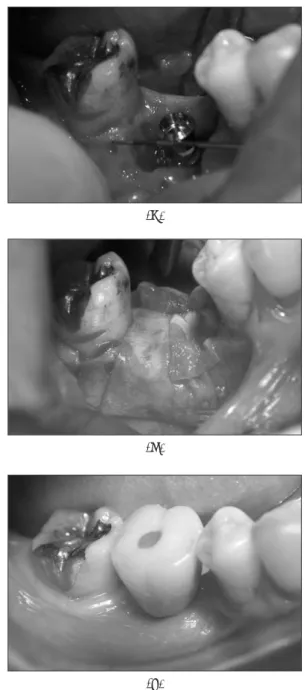 Fig. 2. Case of immediate implantation of lower right first molar(#46).  