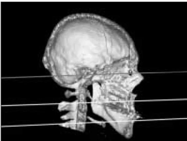 Fig. 2. Air filled space in head and neck area.